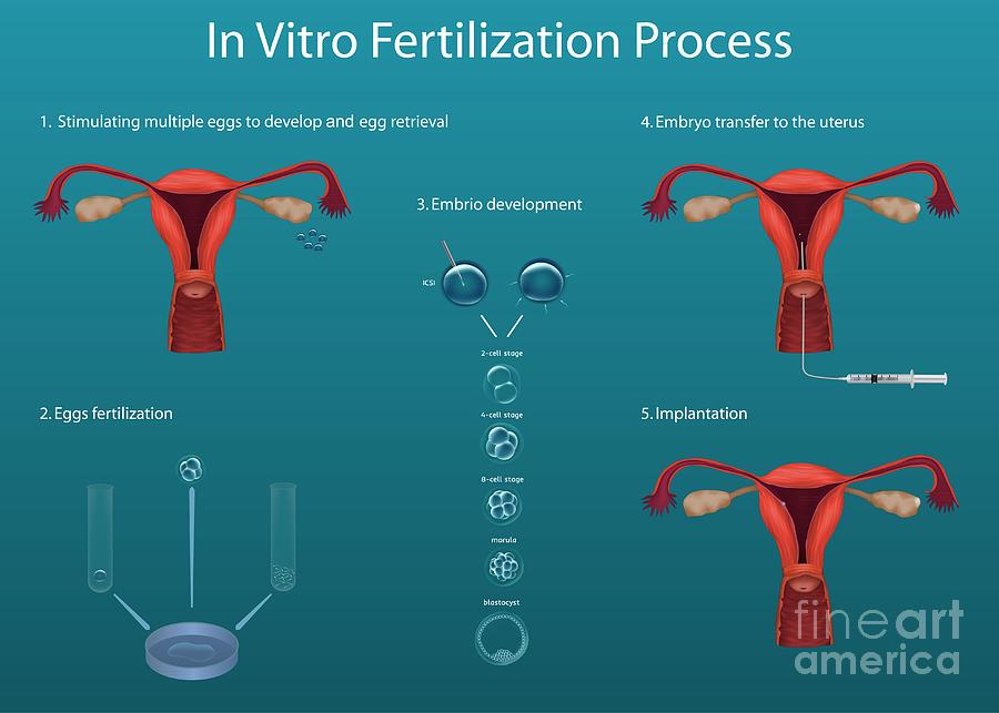 In vitro fertilization это. Insemination process Art. Artificial insemination questions and answers of a Reproductive Doctor. What is Artificial insemination outside the uterus?.