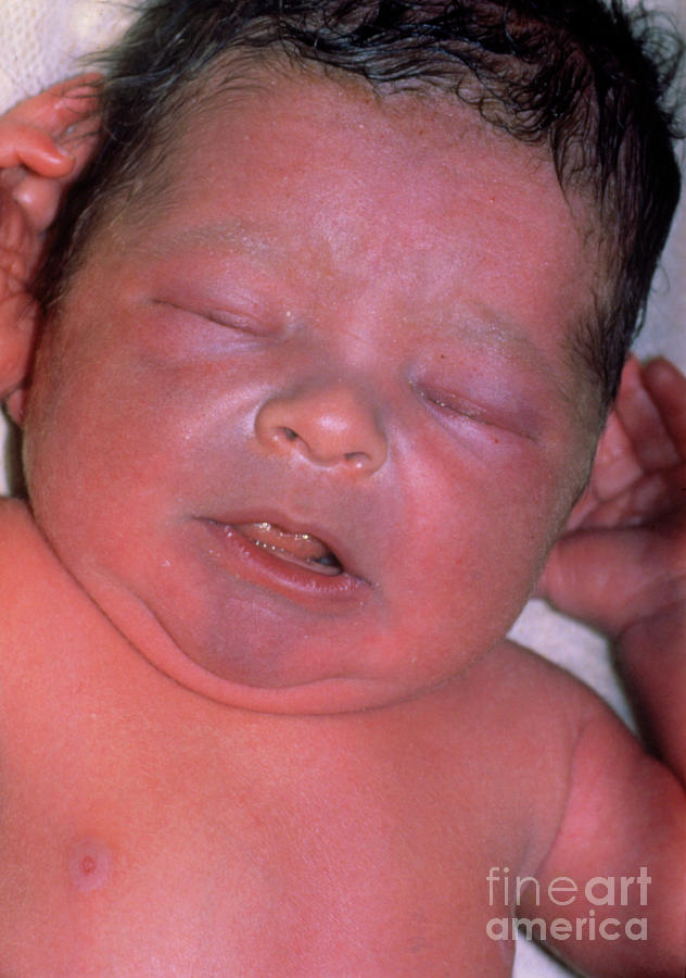 Infant Suffering From Cyanosis Photograph by St Bartholomew's Hospital ...