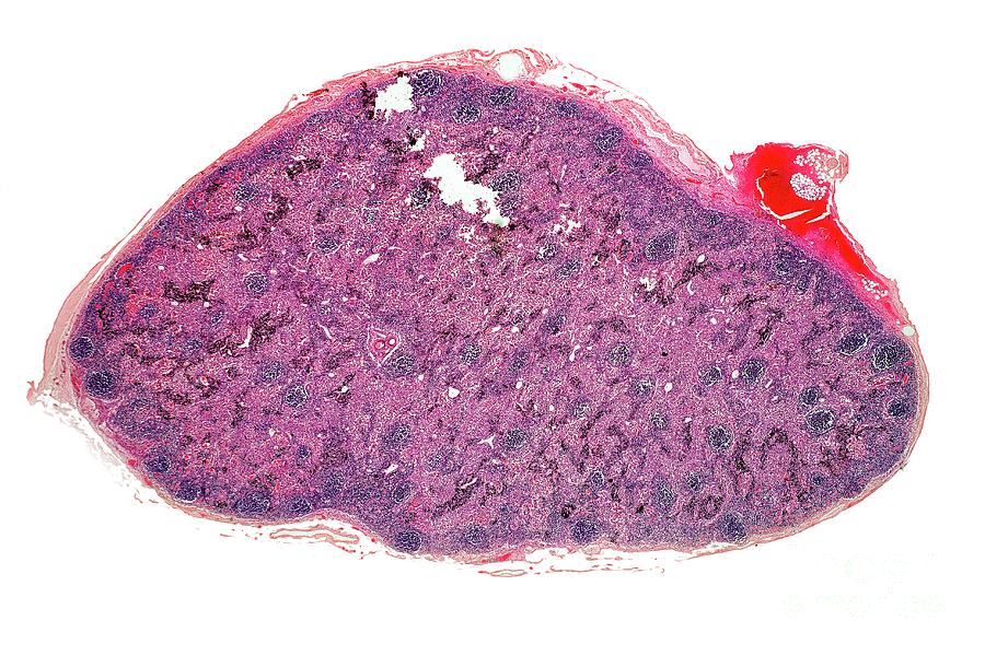 Lymphadenopathy Photograph - Inflamed Lymph Gland by Dr Keith Wheeler/science Photo Library
