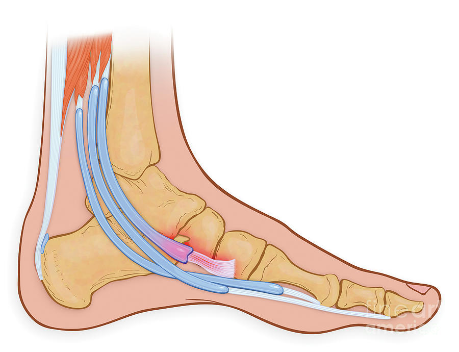 inflamed-tendon-in-foot-photograph-by-medical-imagery-studios-design