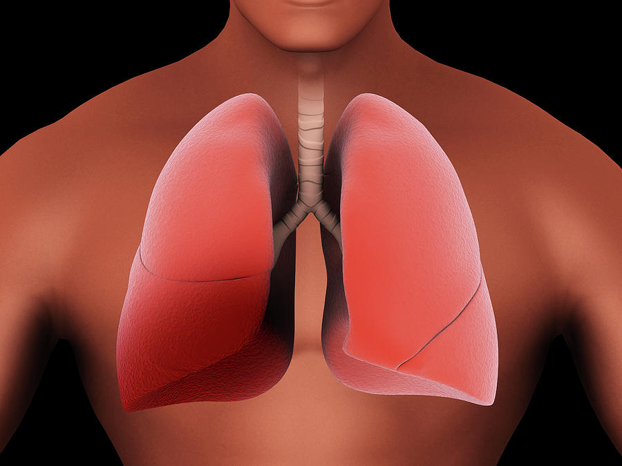 Inflammation In The Human Lungs Caused Photograph by Stocktrek Images