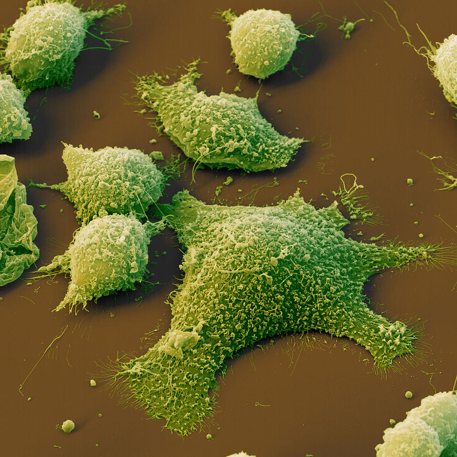Intestinal Cancer Cells Photograph by Meckes/ottawa
