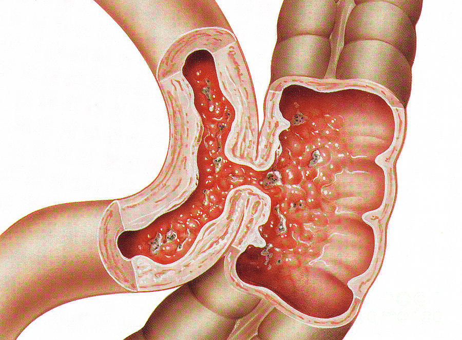 intestinal-fistula-photograph-by-john-bavosi-science-photo-library-pixels