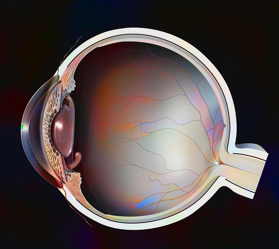 Intra Ocular Implant Photograph by Bsip