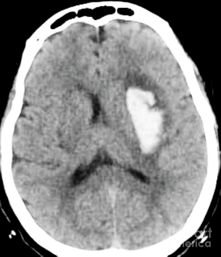 Intracerebral Haemorrhage Photograph by Rajaaisya/science Photo Library ...