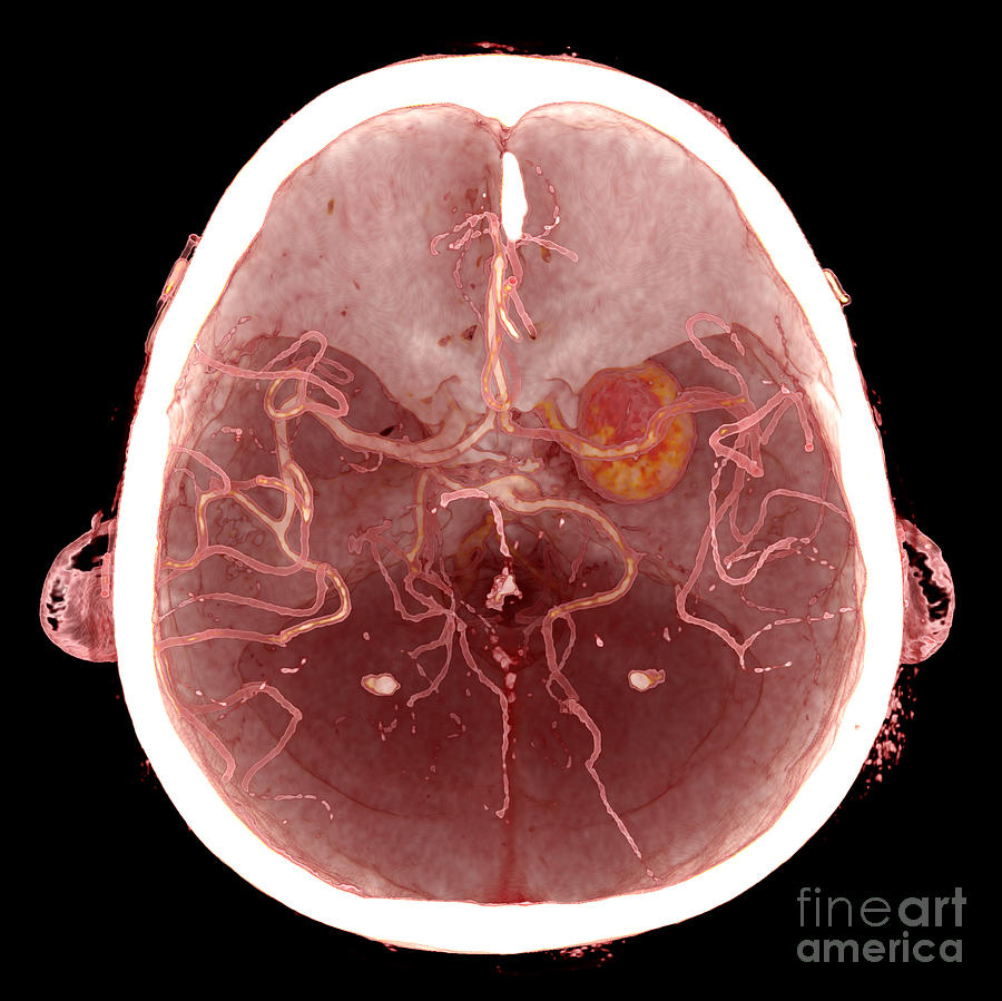 Intracranial Aneurysm by Vsevolod Zviryk/science Photo Library