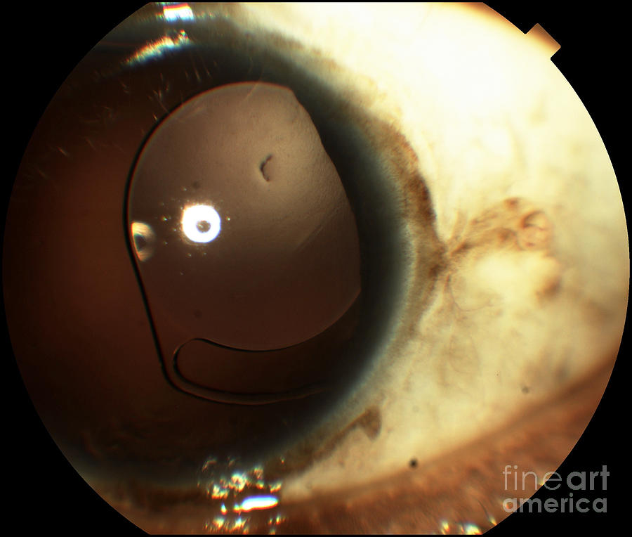 Intraocular Lens Subluxation Photograph by Alan Frohlichstein/science