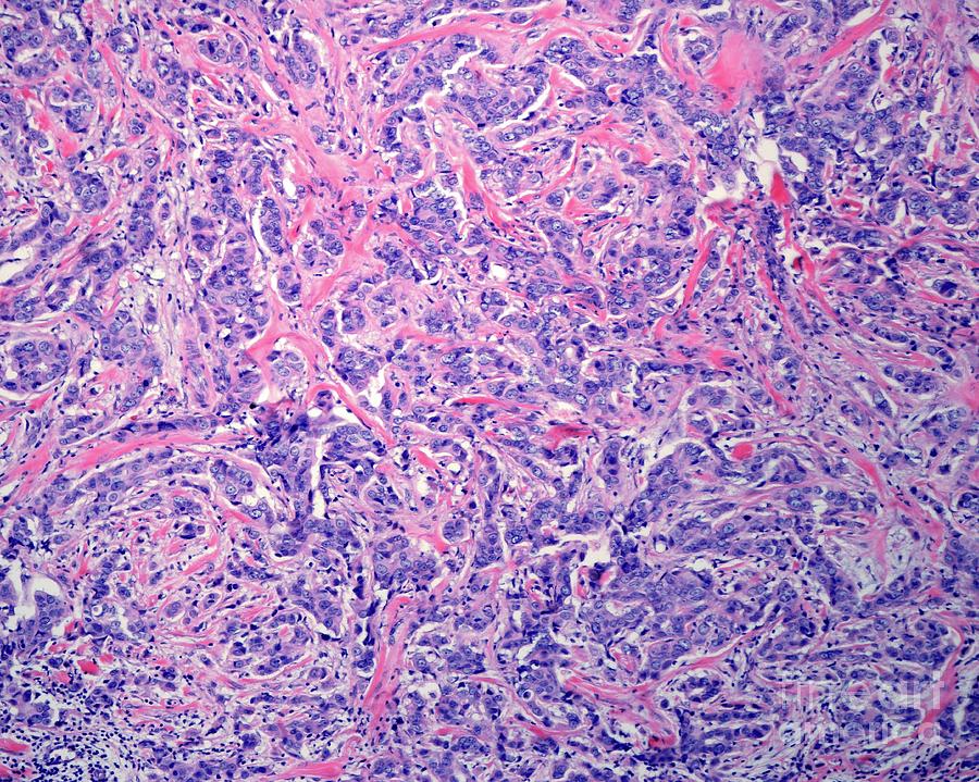 Invasive Carcinoma Of The Breast Photograph by Jose Calvo/science Photo Library