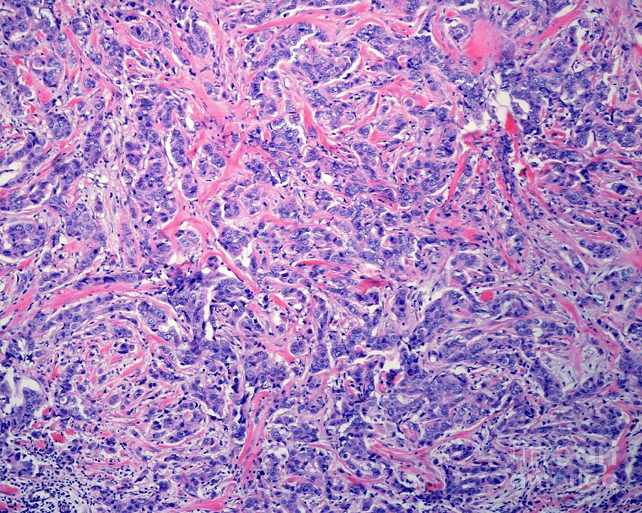 Invasive Carcinoma Of The Breast Photograph By Jose Calvo science Photo 