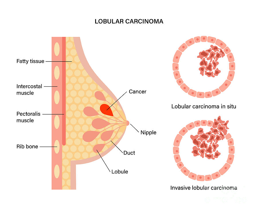 Как выглядит рак околососковой области Invasive Lobular And Carcinoma In Situ by Pikovit / Science Photo Library