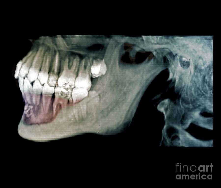 Jaw Tumour Photograph by Zephyr/science Photo Library