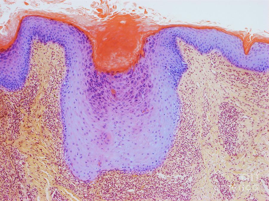 Keratosis Photograph by Steve Gschmeissner/science Photo Library
