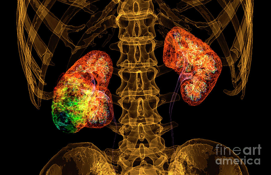 Kidney Cancer Photograph by K H Fung/science Photo Library