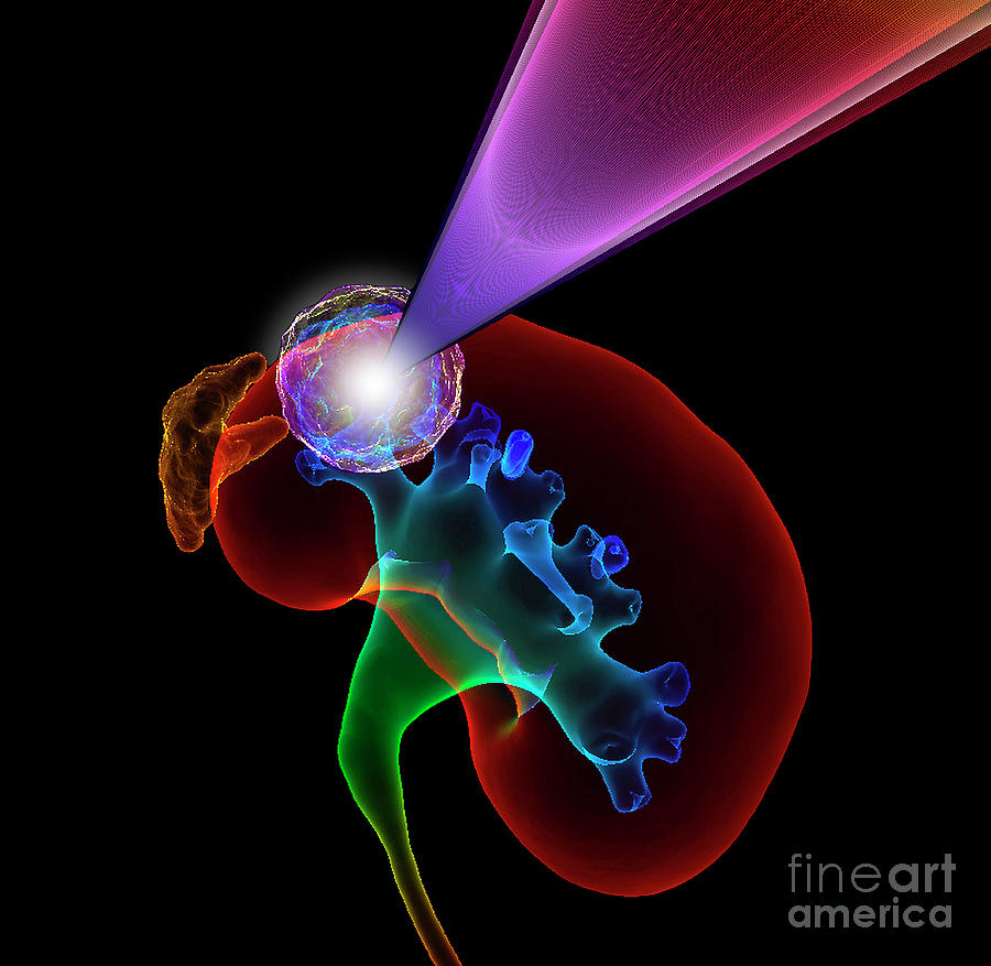 Kidney Cancer Radiotherapy Photograph by K H Fung/science Photo Library