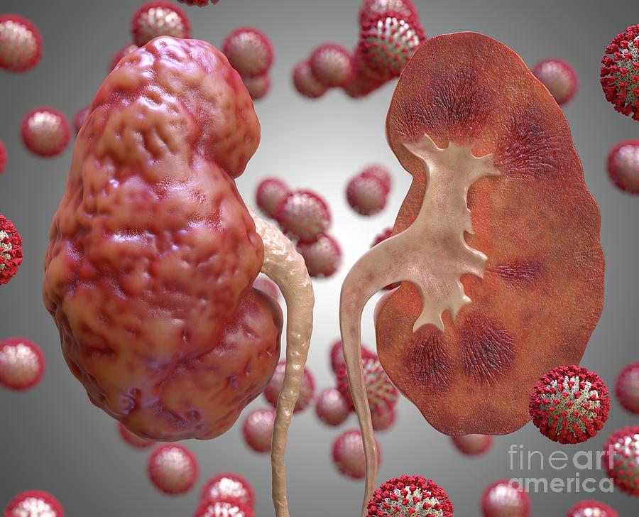 Kidney Inflammation In Covid-19 Photograph by Tim Vernon / Science ...