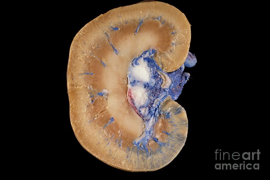 Kidney Median Section Photograph by Carolina Biological Supply Company/science Photo Library