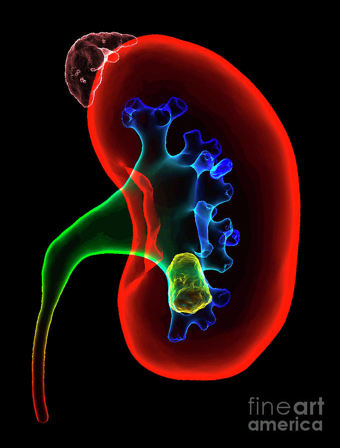 Kidney Stone Photograph by K H Fung/science Photo Library