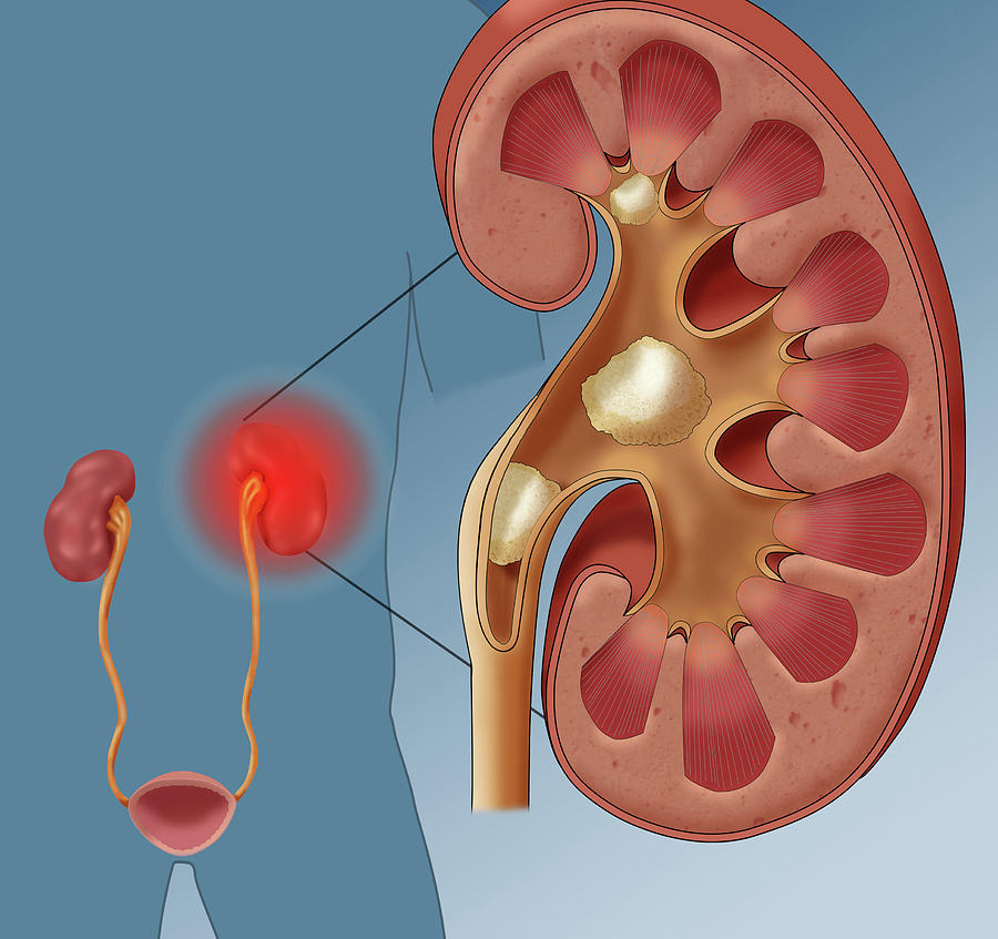 Kidney Stone Pain, Illustration Photograph by Monica Schroeder