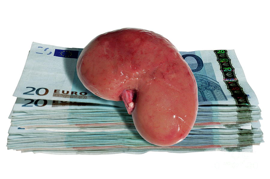 Kidney Transplant Sale Photograph by Victor De Schwanberg/science Photo Library