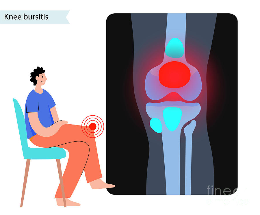 Knee Bursitis By Science Photo Library