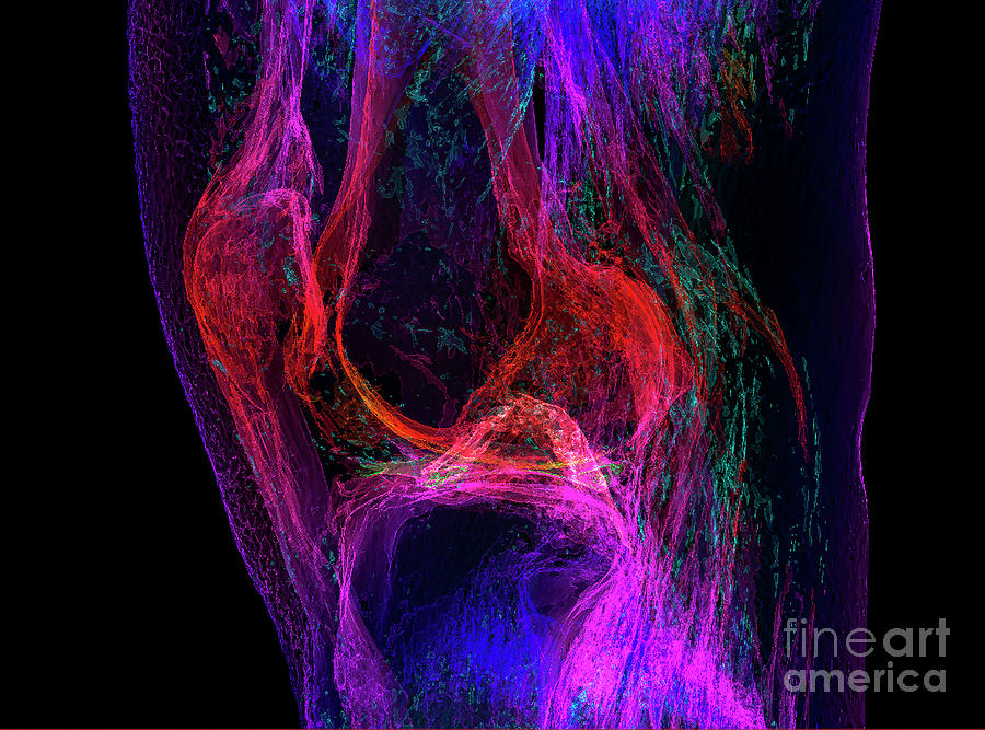 Knee Joint Photograph by K H Fung/science Photo Library