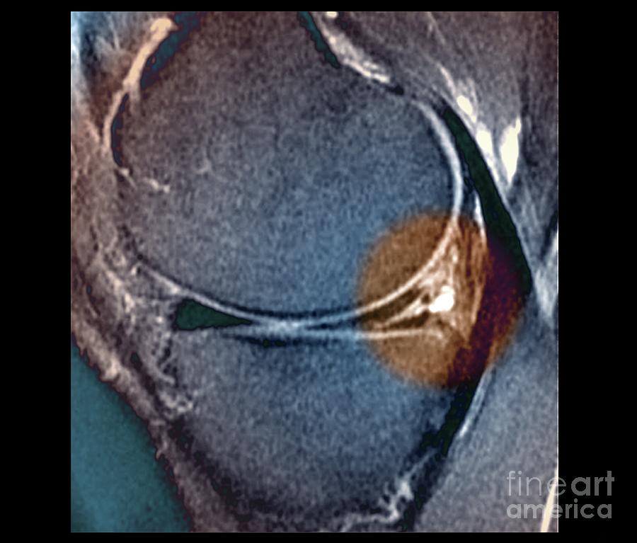 Knee Meniscus Injury Photograph by Zephyr/science Photo Library