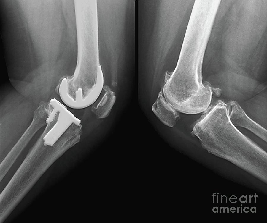 Black And White Photograph - Knee Osteoarthritis And Total Knee Replacement by Zephyr/science Photo Library