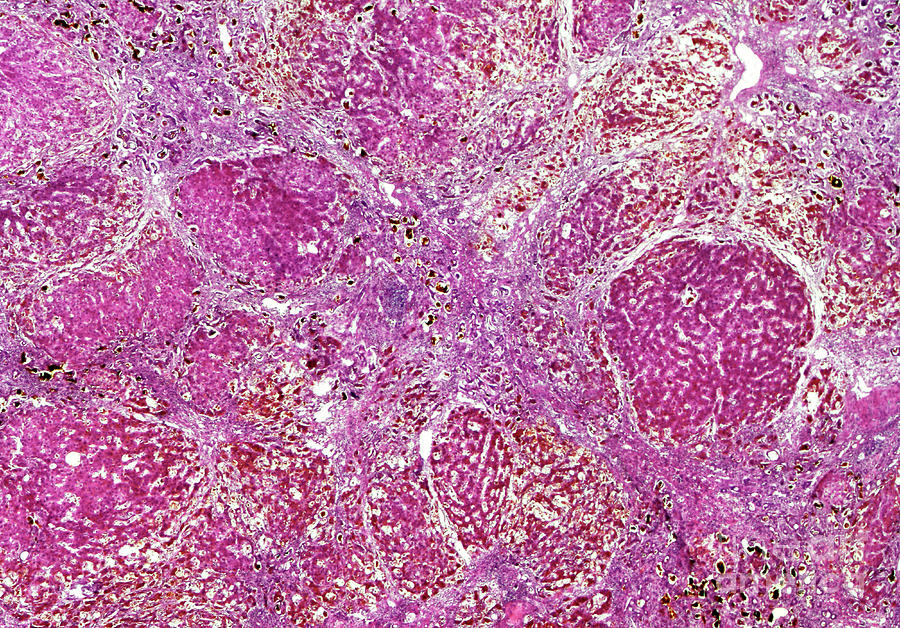 Laennec's Cirrhosis Of The Liver Photograph by Nigel Downer/science ...