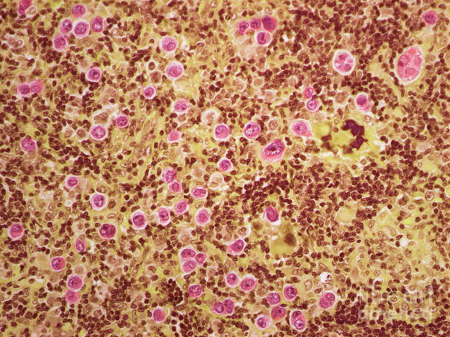 Large B Cell Lymphoma Photograph by Steve Gschmeissner/science Photo Library