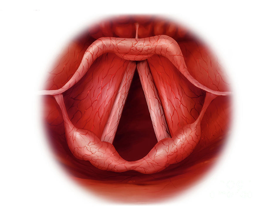 Laryngitis Photograph by Medical Graphics/michael Hoffmann/science Photo Library