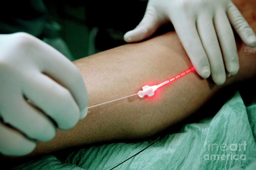 Laser Treatment Of Varicose Veins Photograph by Arno Massee/science Photo Library