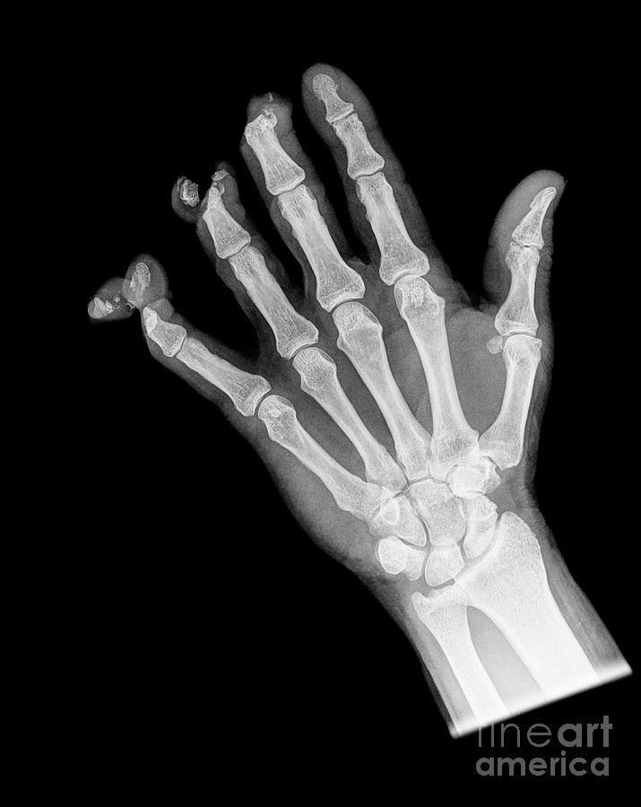 Lawnmower Finger Injuries Photograph by Science Photo Library | Fine ...