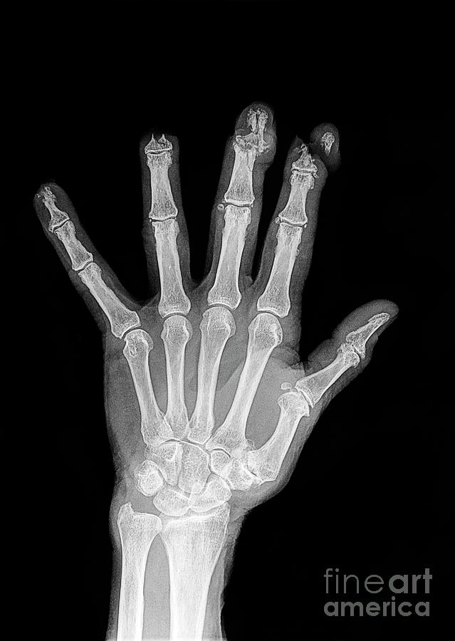 Lawnmower Hand Injury Photograph by Science Photo Library - Fine Art ...