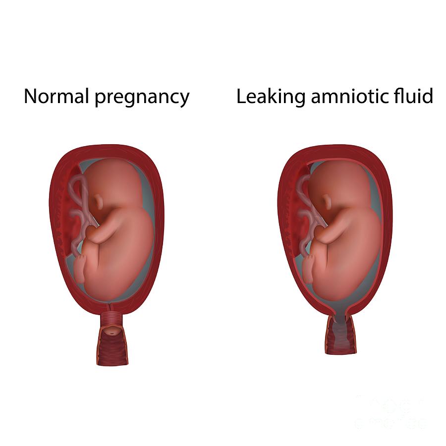 signs of leaking amniotic fluid vs. discharge