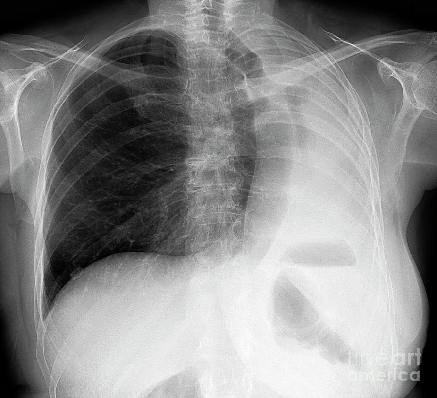 Left Pneumonectomy Photograph by Science Photo Library