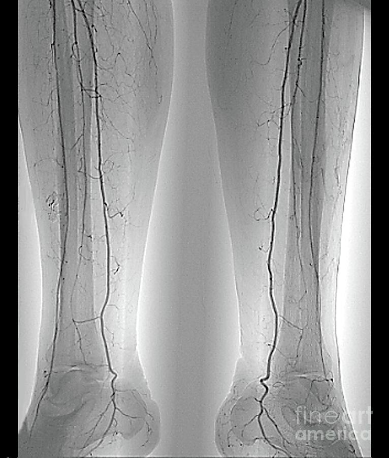 Leg Arteries Photograph by Zephyr/science Photo Library