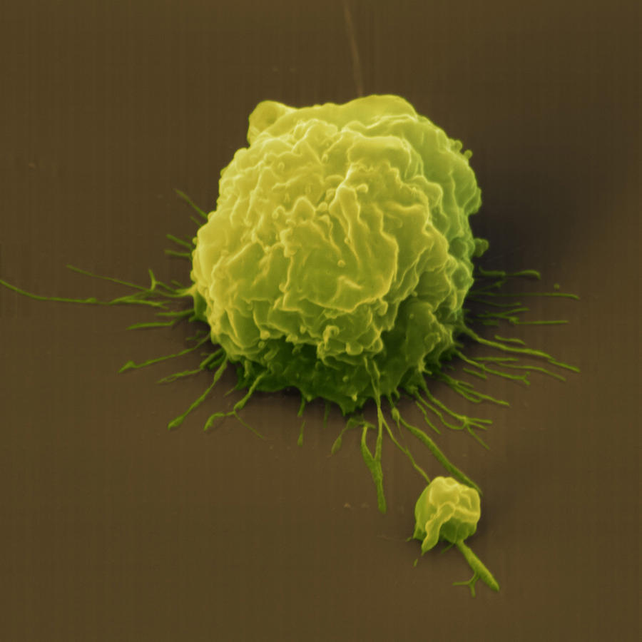 Leukemia Cell Photograph by Meckes/ottawa