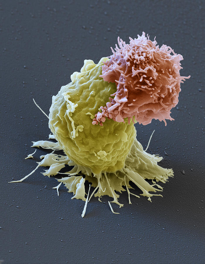 Leukemia Cell With Car T-cell, Sem Photograph by Oliver Meckes EYE OF SCIENCE