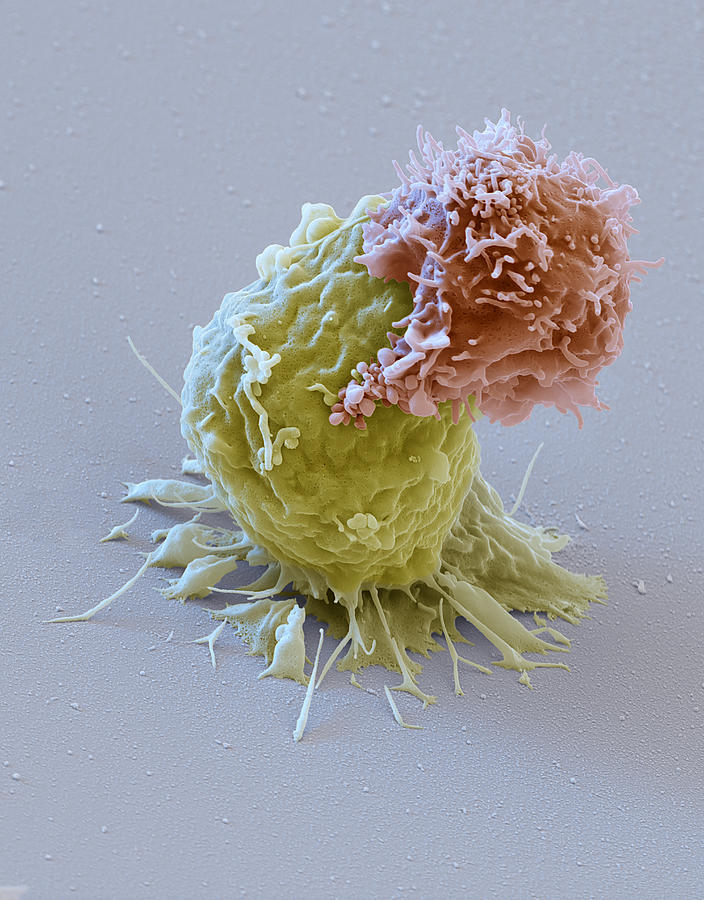 Leukemia Cell With Car T-lymphocyte, Sem Photograph by Oliver Meckes EYE OF SCIENCE