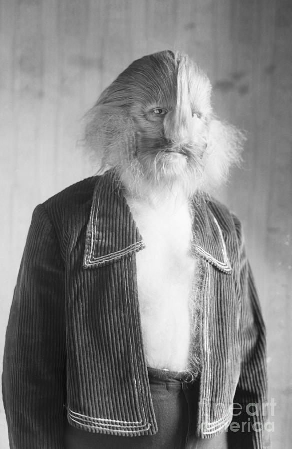 Lionel Bilrouki, The Lion-faced Man Photograph by Bettmann
