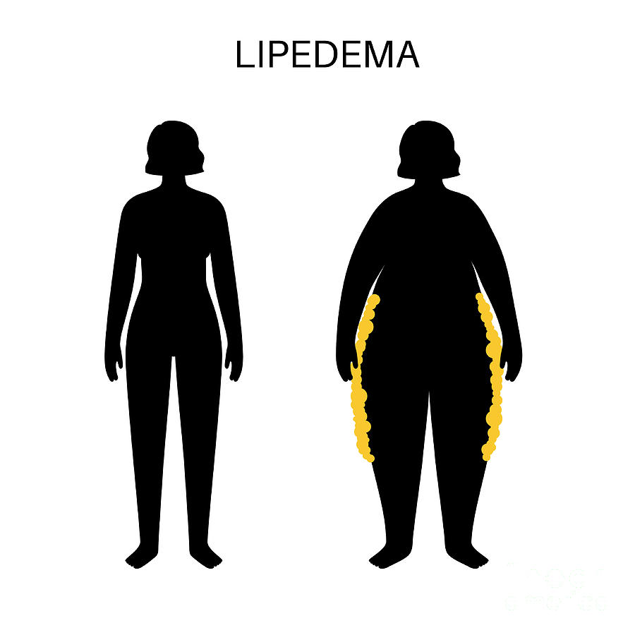 Lipoedema Fat Zones Photograph by Pikovit / Science Photo Library