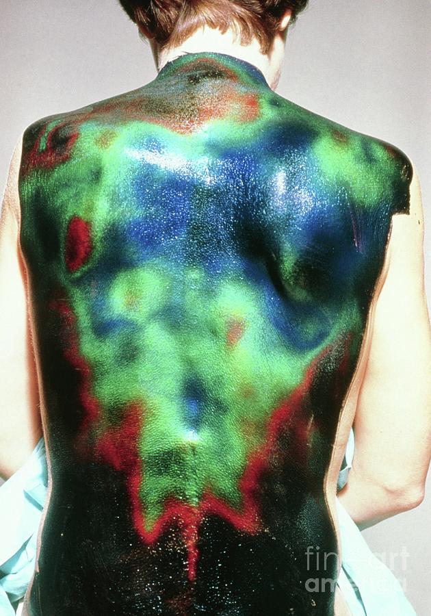 Liquid Crystal Thermography Of A Back Injury Photograph by Alfred Benjamin/science Photo Library