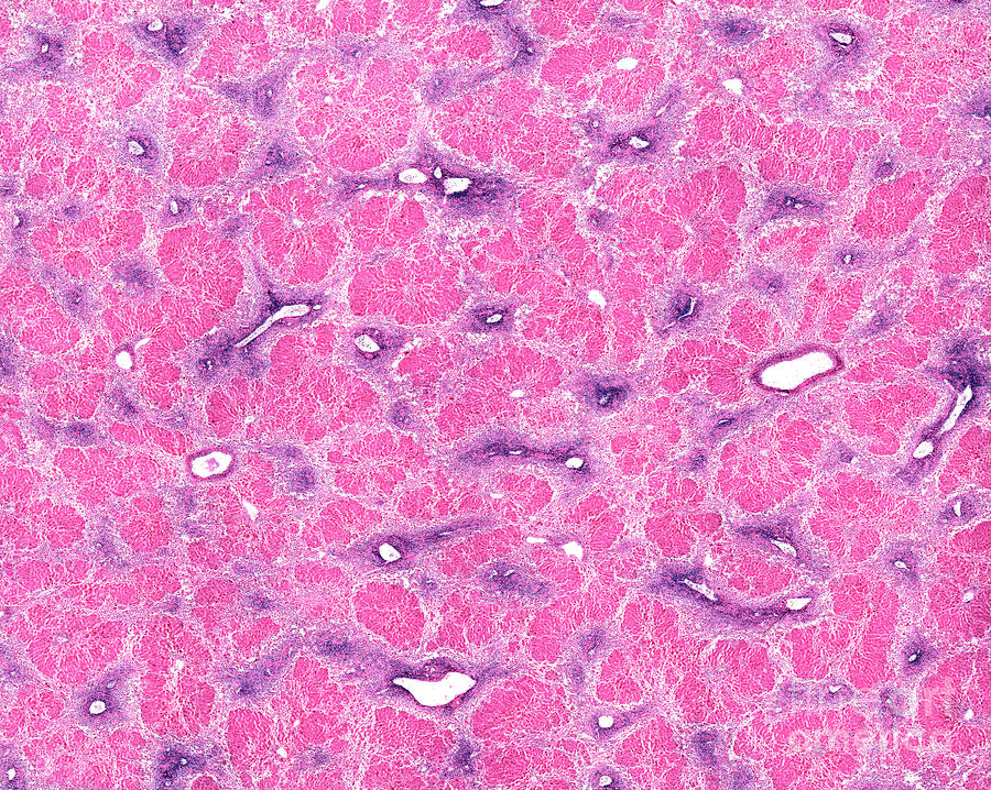 Liver Necrosis Photograph by Jose Calvo/science Photo Library - Pixels ...