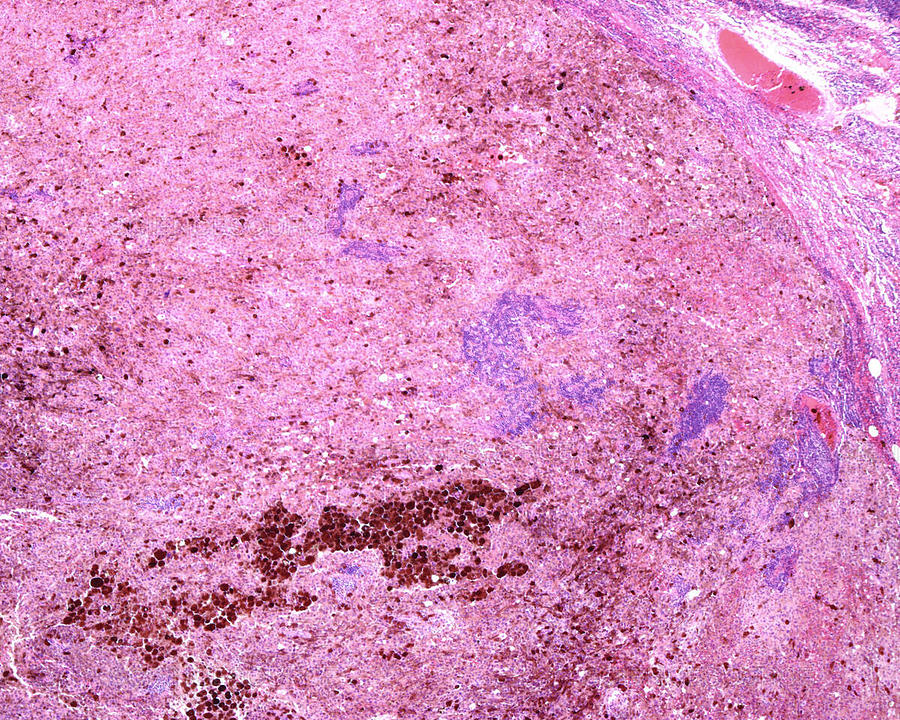 Lm Of Lymph Node, Melanoma Metastasis by Jose Luis Calvo