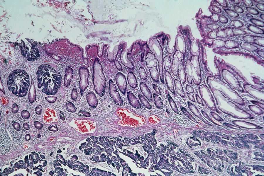 Lm Showing Adenocarcinoma Of Human Colon Photograph by Biophoto Associates/science Photo Library