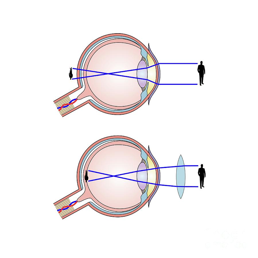 Long-sightedness Corrected Photograph by Science Photo Library - Pixels