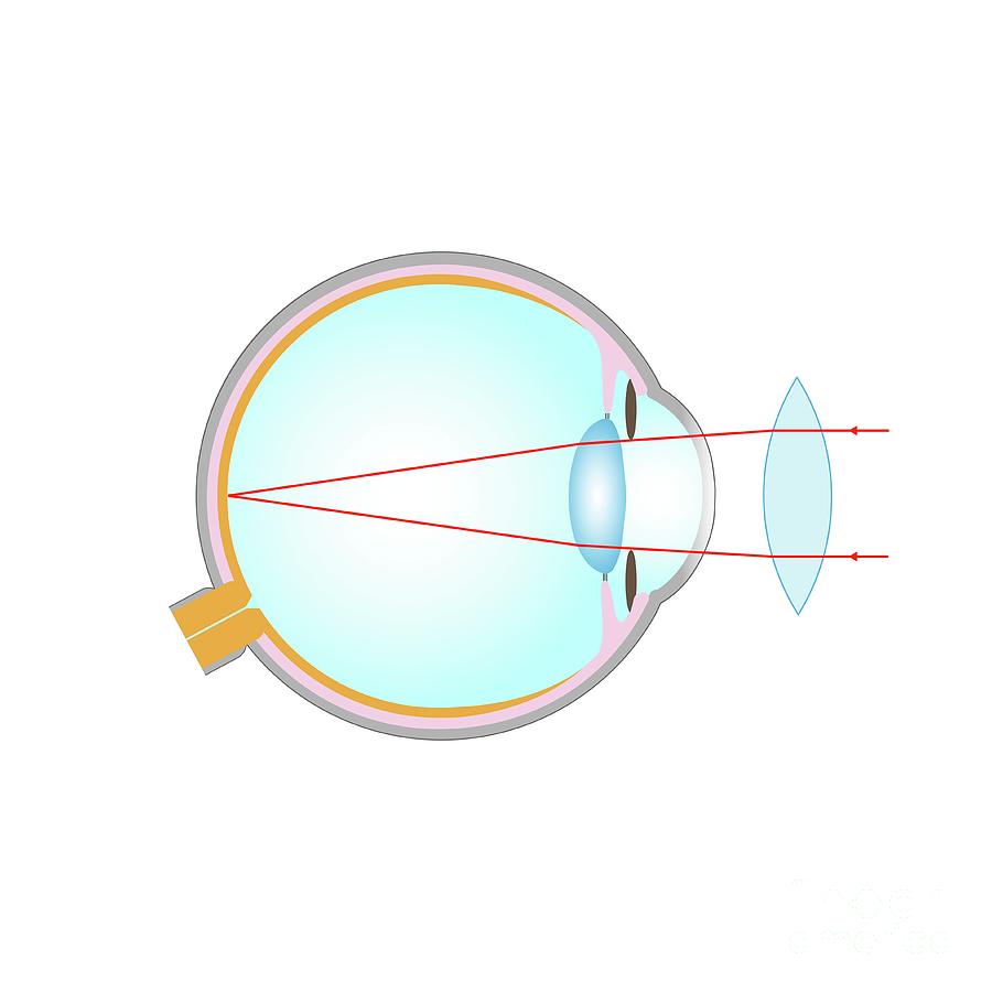 Long Sightedness Corrected With Convex Lens Photograph by Cordelia Molloy/science Photo Library