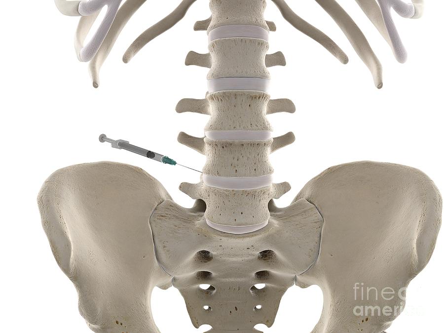 Lumbar Spine Injection Photograph by Sebastian Kaulitzki/science Photo Library Fine Art America