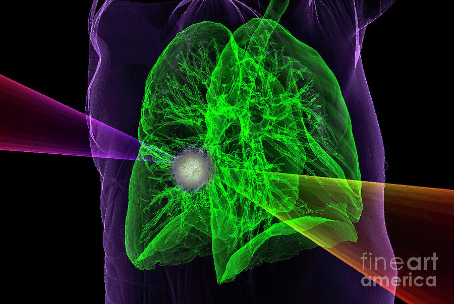 Lung Cancer Radiotherapy Photograph By K H Fung Science Photo Library Fine Art America