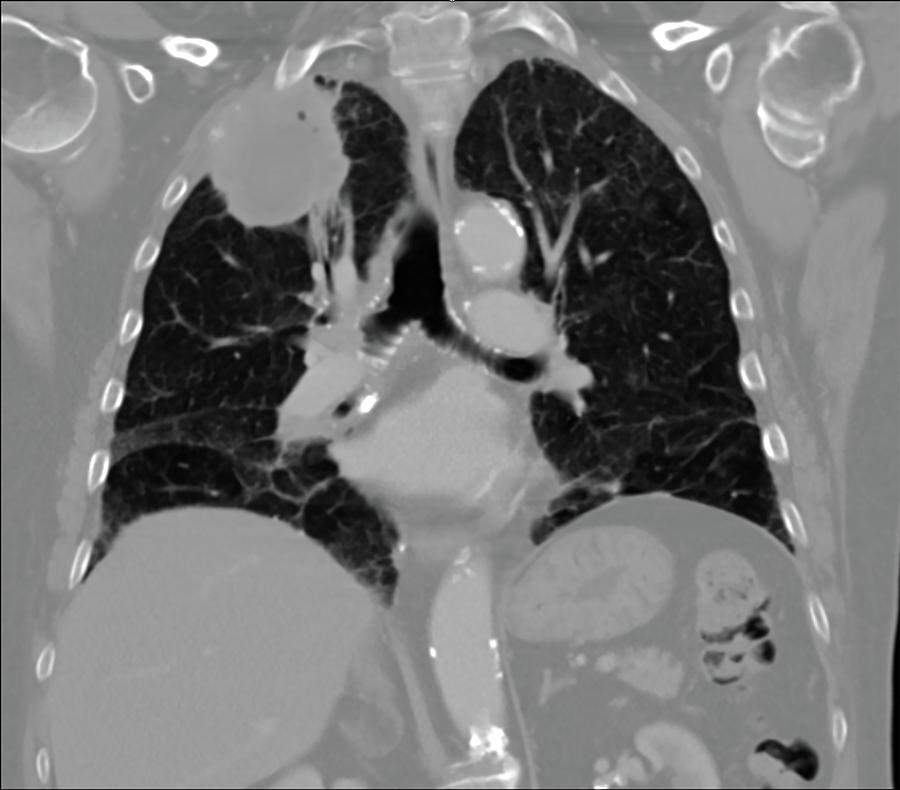 Lung Carcinoma, Ct Photograph by Steven Needell - Fine Art America